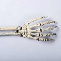 Cáncer de Huesos / OSTEOSARCOMA