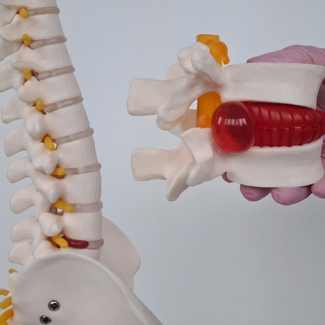 Hernias Discales