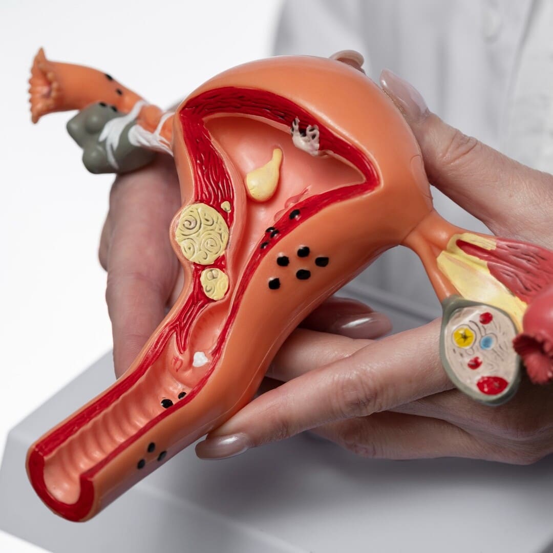 SOP Síndrome de Ovario Poliquístico